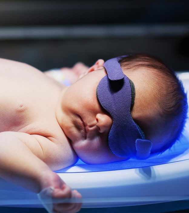 neonatal jaundice babies