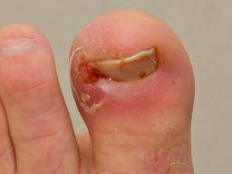 What is an Ingrown Nail and How Can You treat it? - Mycovergenius Blog