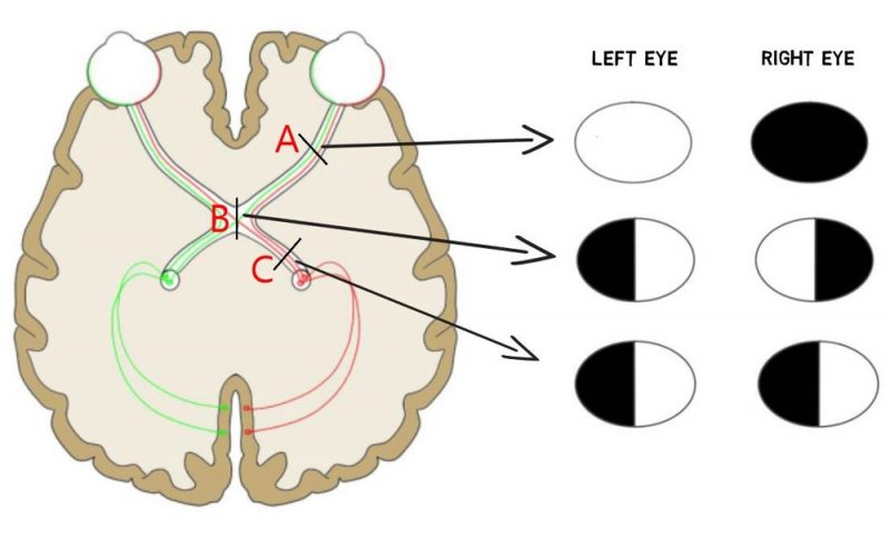 Visual Defects and Correction - Mycovergenius Blog